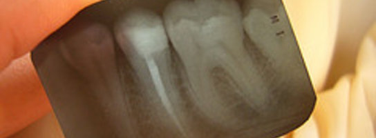 Implanty zębów coraz bardziej dostępne